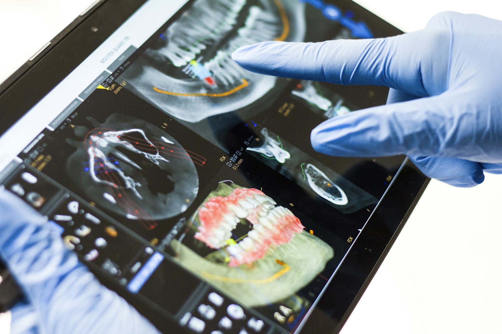 A gloved hand pointing at a dental X-ray on a tablet screen